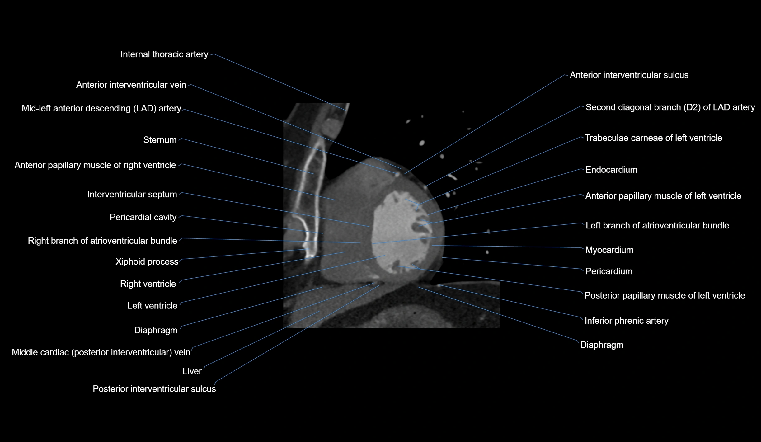 CT heart (coronary angiogram) short axis view  cross sectional anatomy labelled radiology image-00036.webp